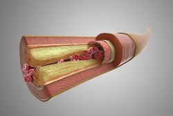 Atherosclerosis